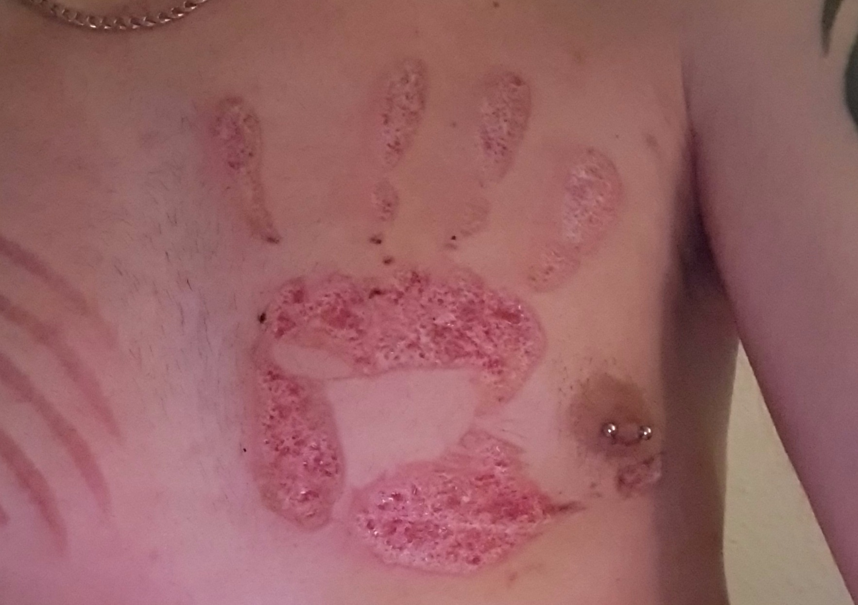 Hand Cutting - Scarification - skinremoval - Piercen und Bodymodification lernen Deutschland  - #modsbyben