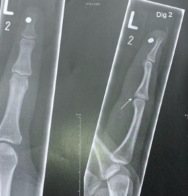 Magnet Implantat Bodymodificationangebot in Deutschland: Cutting, Implantate, Beadings Zungenspaltung sowie Piercing Ausbildung, Piercer werden, Piercing Kurs, Piercer Seminar und Bodymods lernen auf piercen-lernen.de