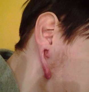 großer Ohr Tunnel - Ohrläppchen gerissen - piercen lernen und Piercer werden in der Piercing Ausbildung auf piercen-lernen.de oder piercerfernschule.de I #modsbyben