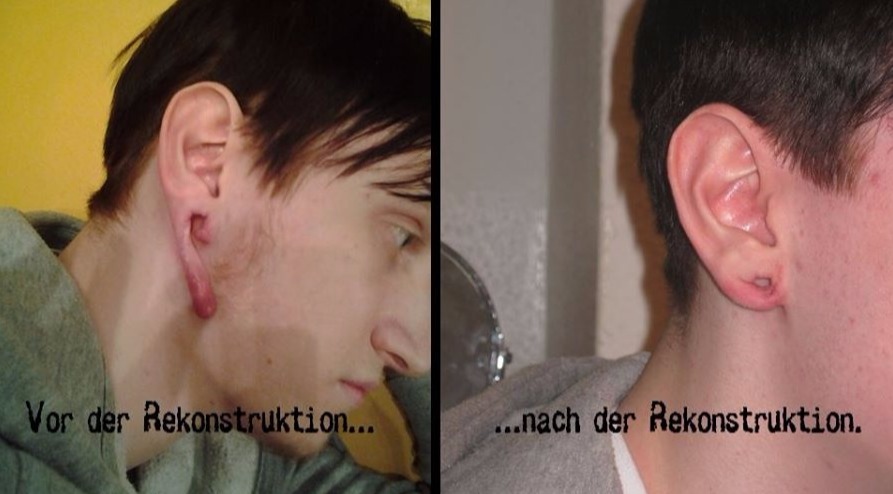 Ohrloch rekonstruieren oder Tunnel gerissen und wieder nähen - Cutting, Implantate, Beadings Zungenspaltung sowie Piercing Ausbildung, Piercer werden, Piercing Kurs, Piercer Seminar und Bodymods lernen auf piercen-lernen.de #modsbyben 